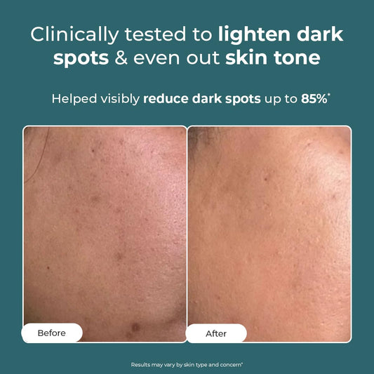 Conscious Chemist Kojic Acid Face Cream | 20g | Azelaic Acid Cream for Men & Women with Niacinamide | Anti Pigmentation, Reduce Dark Spots, All Skin Type - Trubiom