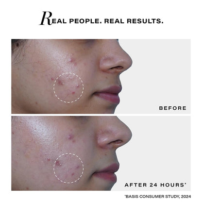 Novology Acne Spot Corrector Gel | For Active Acne, Pimples, Whiteheads | 30g