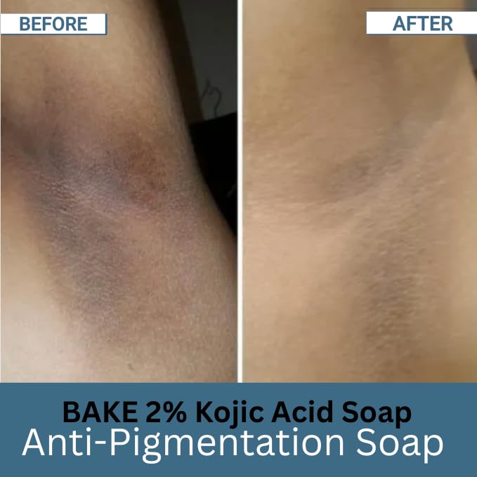 BAKE 2% Kojic Acid Scrub Treatment Soap (1 Pcs) with Alpha Arbutin, Lactic Acid & Niacinamide | For Pigmentation, Dark Spots, Tan Removal, Brightens Underarms | Soap for Women & Men | 100g x 1