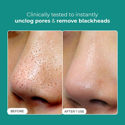 Conscious ChemistÂ® Blackhead Melting Water 130ml + Silicone Brush | Gentle Pore Treatment with Succinic, Glycolic Acid & CICA Exosome | Unclogs Pores, Removes Blackheads & Smoothens Skin | For Men & Women