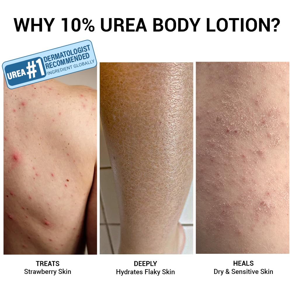 Sereko 10% Urea & Avocado Oil Body Lotion 30ML | For Strawberry legs, Detans, Rough Bumpy skin| Body lotion for Men & Women | AHA BHA free | Gentle Exfoliating | with 48H Moisturization | Very dry, flaky skin