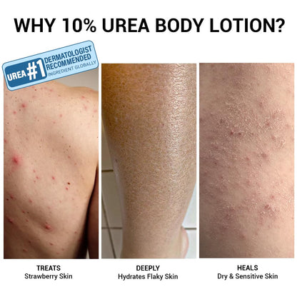 Sereko 10% Urea & Avocado Oil Body Lotion 30ML | For Strawberry legs, Detans, Rough Bumpy skin| Body lotion for Men & Women | AHA BHA free | Gentle Exfoliating | with 48H Moisturization | Very dry, flaky skin