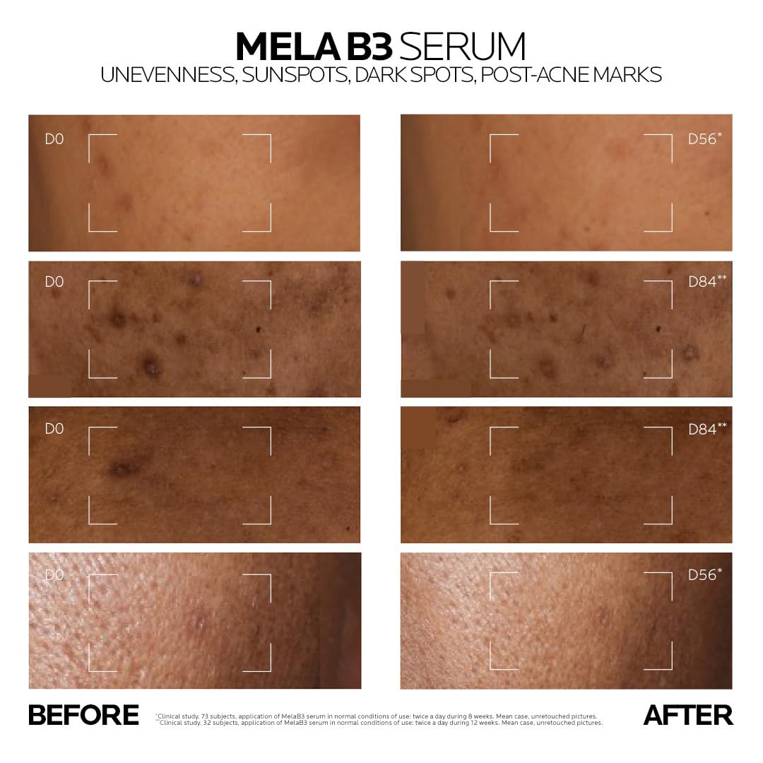La Roche-Posay Mela B3 Anti-Dark Spot Serum |Corrects Pigmentation, Sun Spots, Age Spots & Post-Acne Marks with Melasyl + 10% Niacinamide for even skin, 30 ml