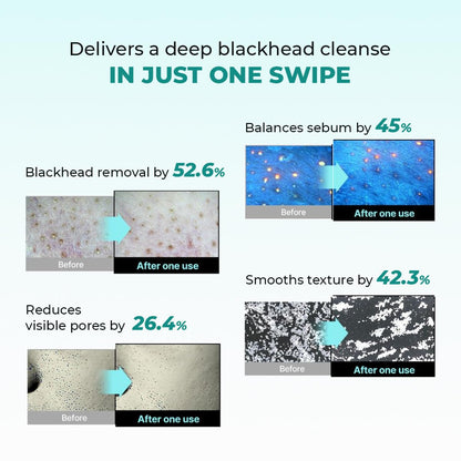 Conscious ChemistÂ® Blackhead Melting Water 130ml + Silicone Brush | Gentle Pore Treatment with Succinic, Glycolic Acid & CICA Exosome | Unclogs Pores, Removes Blackheads & Smoothens Skin | For Men & Women