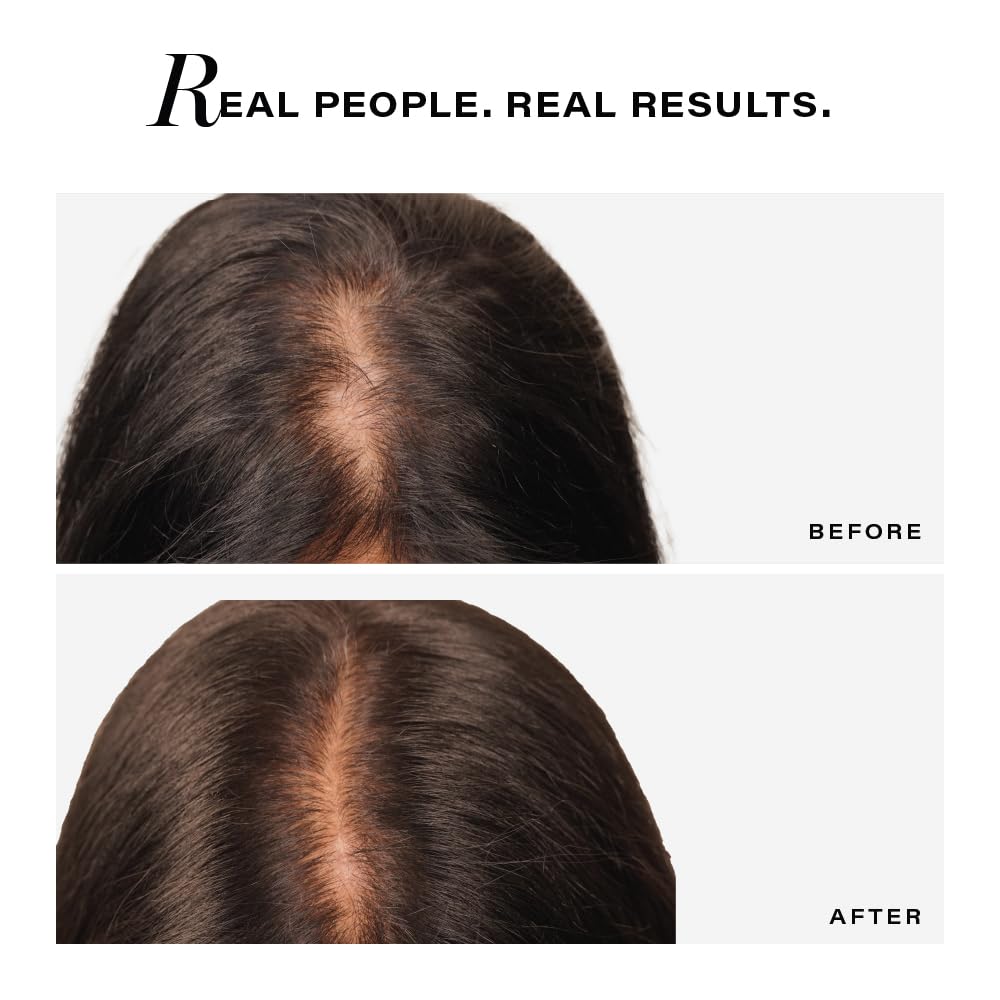 Novology Follicle Revive Scalp Serum for Hair Growth with 4% Dynagen, Zinc, Niacinimide|50ml