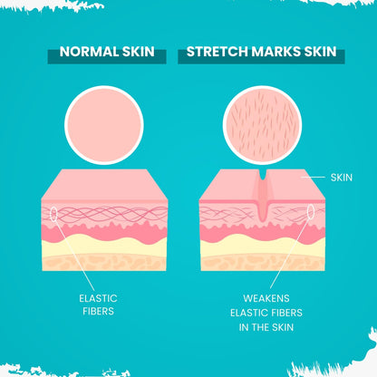 MildCares Stretch Marks Removal Cream (50gm) | For Prevents Stretch Marks, Nourish & Hydrating Skin | With Shea Butter, Saffron, Kokum Butters | All Skin Types | Stretch Marks Cream For Women