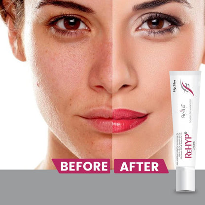 Rehyp Pigmentation Cream for Women â€“ Dark Spot Remover, Brightening Face Cream with Kojic Acid & Alpha Arbutin â€“ Paraben-Free, Dermatologically Tested â€“ 15g