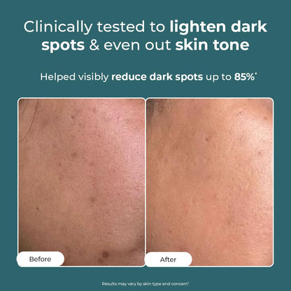 Conscious Chemist Kojic Acid Face Cream | 20g | Azelaic Acid Cream for Men & Women with Niacinamide | Anti Pigmentation, Reduce Dark Spots, All Skin Type - Trubiom