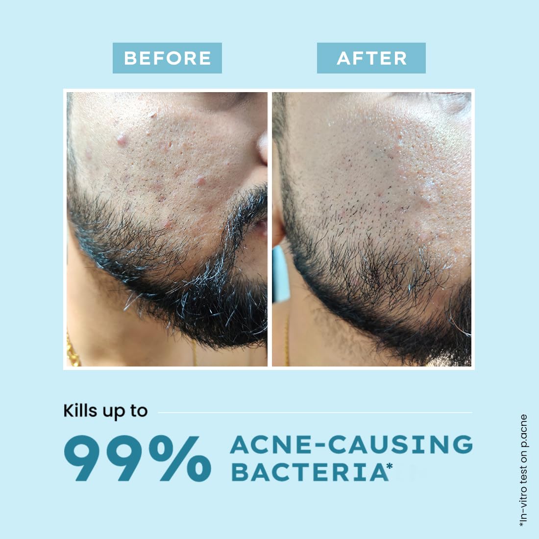 Hyphen Clarifying Acne Face Wash for Women and Men | Cleanser For Acne Prone Skin with Salicylic Acid 2%, Zinc PCA, Witch Hazel 10% | Oil Control Pore Cleasning | Antibacterial & Non-Drying - 100ml