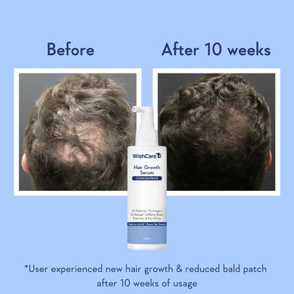 WishCare Hair Growth Serum For Scalp | 94% Saw New Hair Growth | Redensyl & Rosemary Oil | 100% Saw Hairfall Reduction | In-Vivo Tested | For Men & Women | 100ml