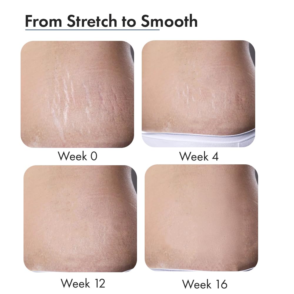 ThriveCo Stretch Marks Expert Serum Cream | Clinically Proven Treatment for New red & Old white Stretch Marks & Scars Removal | Infused with CollarevÂ®, Strioverâ„¢, Rosehip Oil | Women & Men (Stretch Marks 30ML)