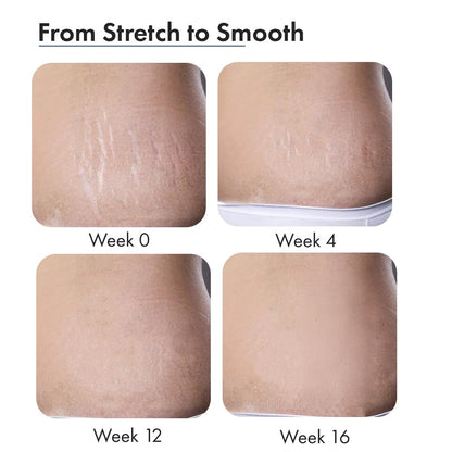 ThriveCo Stretch Marks Expert Serum Cream | Clinically Proven Treatment for New red & Old white Stretch Marks & Scars Removal | Infused with CollarevÂ®, Strioverâ„¢, Rosehip Oil | Women & Men (Stretch Marks 30ML)