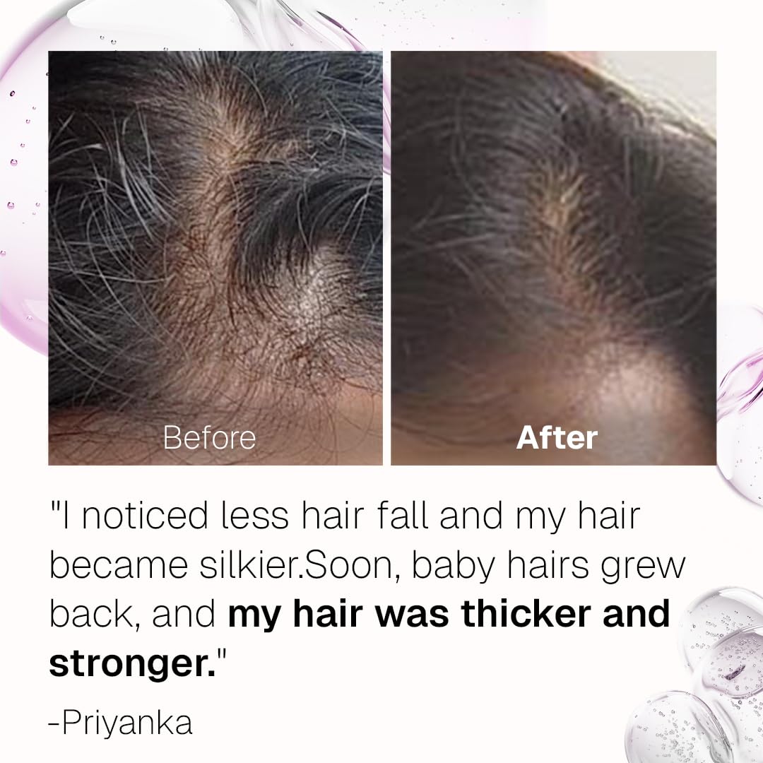 Bontress PRO+ Scalp Serum | Powered by Pro Active Peptides â€“ 5% Capixyl, 3% Redensyl, 3% Anagain, 3% Procapil | Dermat recommended Hair Growth Serum | 94% Users Reported Hair Growth in 28 Days | 30ml