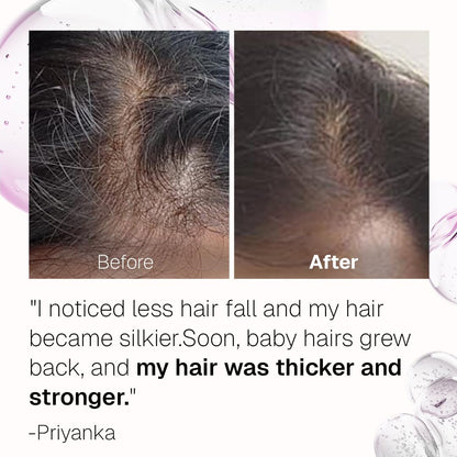 Bontress PRO+ Scalp Serum | Powered by Pro Active Peptides â€“ 5% Capixyl, 3% Redensyl, 3% Anagain, 3% Procapil | Dermat recommended Hair Growth Serum | 94% Users Reported Hair Growth in 28 Days | 30ml