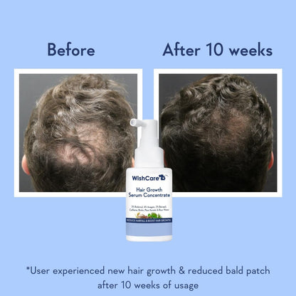 WishCare Hair Growth Serum Concentrate - 3% Redensyl, 4% Anagain, 2% Baicapil, Caffeine, Biotin, Plant Keratin & Rice Water - Hair Growth Serum For Men & Women, 30ml