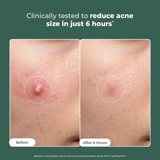 Conscious ChemistÂ® Rapid Relief Acne Spot Corrector Gel | 15g | Triple-Action Treatment with 2% Salicylic Acid & Azelaic Acid | Clears Pimples, Reduces Redness & Fades Dark Spots | For Men & Women