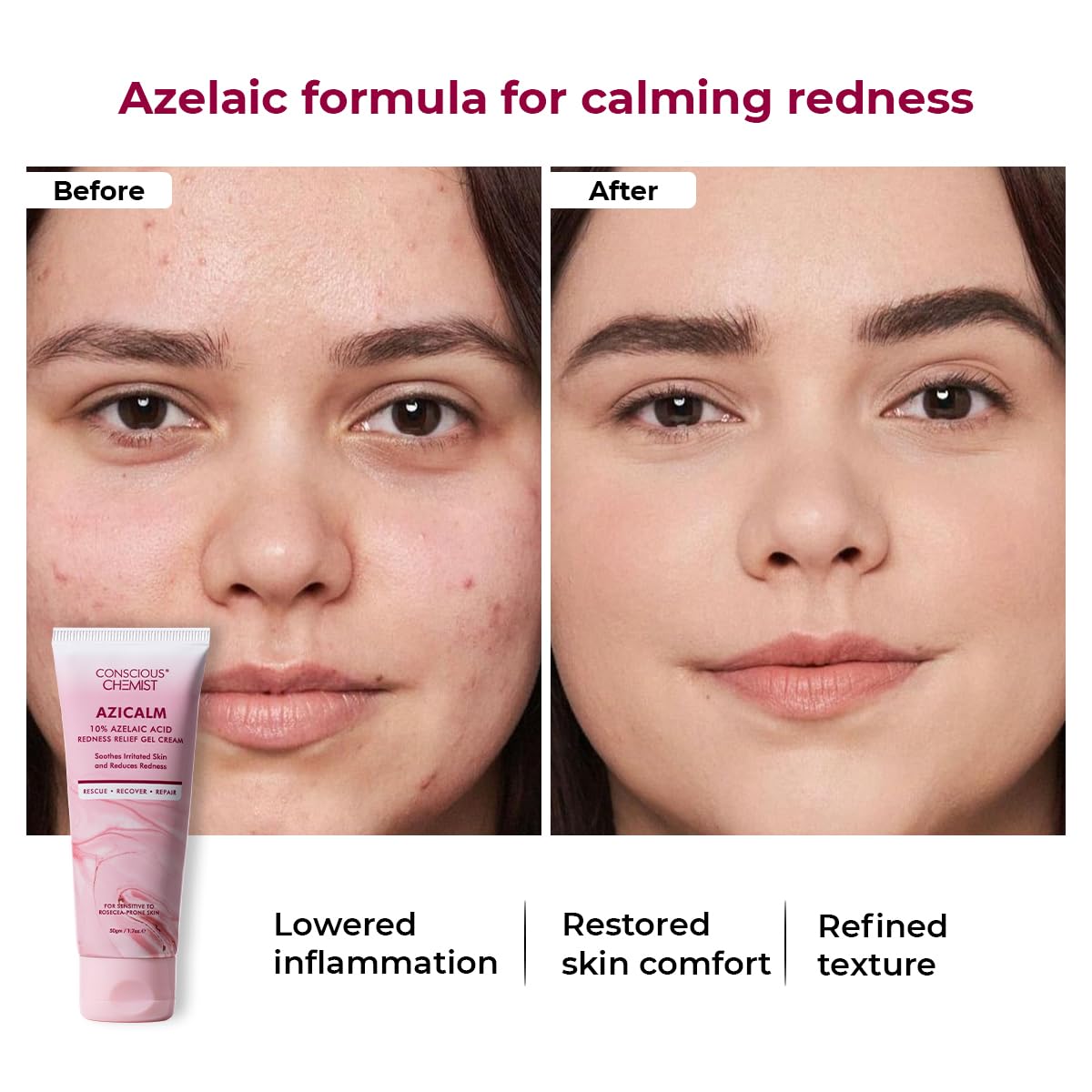Conscious ChemistÂ® 10% Azelaic Acid Cream | 50g | Face Cream for Men & Women, Moisturizer for Acne Prone Skin, Redness Relief, Soothe Irritation & Inflammation, All Skin Types - Azicalm