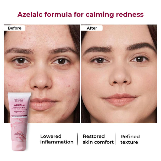 Conscious ChemistÂ® 10% Azelaic Acid Cream | 50g | Face Cream for Men & Women, Moisturizer for Acne Prone Skin, Redness Relief, Soothe Irritation & Inflammation, All Skin Types - Azicalm