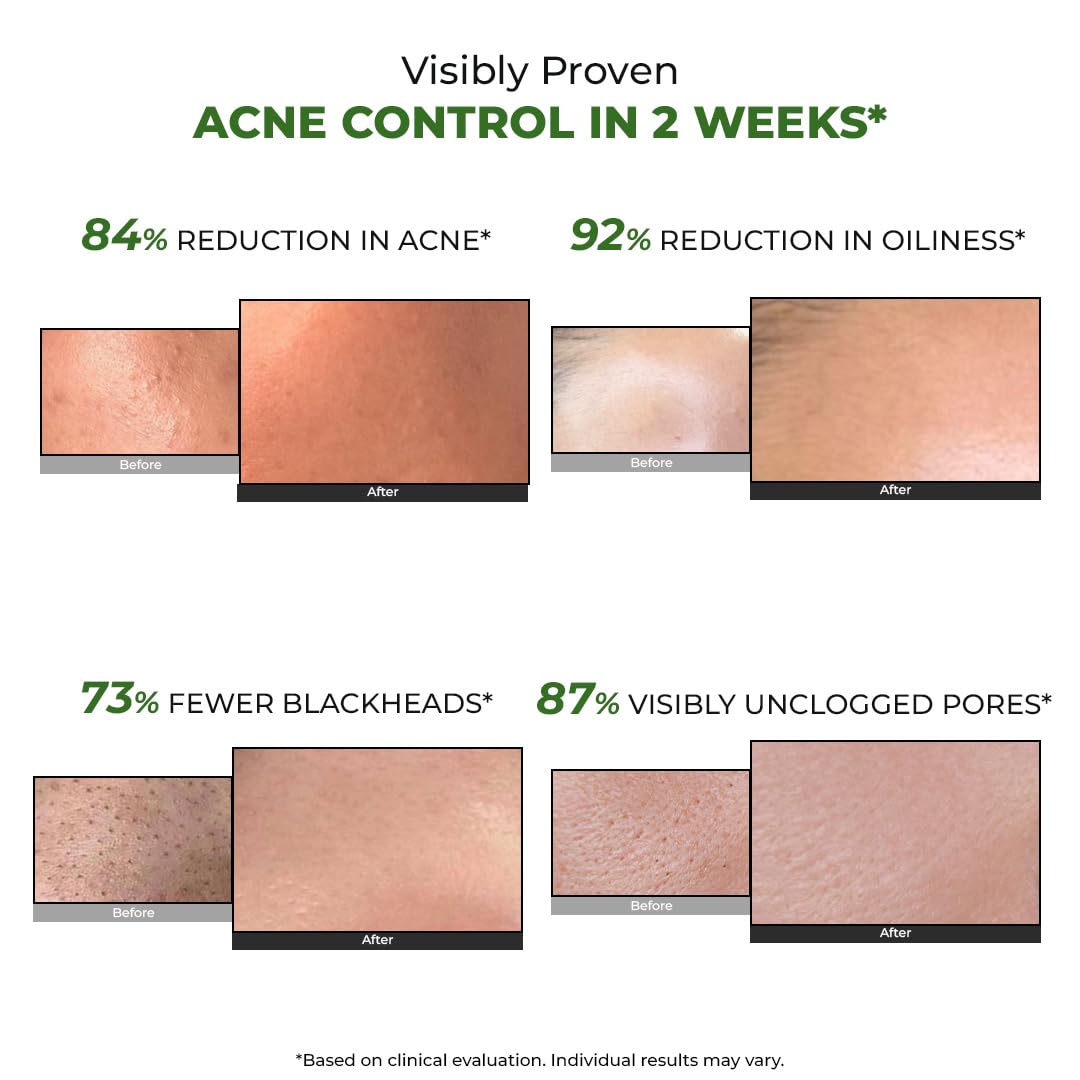 Conscious ChemistÂ® 2% Salicylic Acid Cream | 50g | Acne Spot Corrector | Moisturizer for Oily Acne Prone Skin, Face Cream for Men & Women, Overnight Acne & Oil Control, Itchiness & Redness, Non greasy Gel Cream - Flashfix