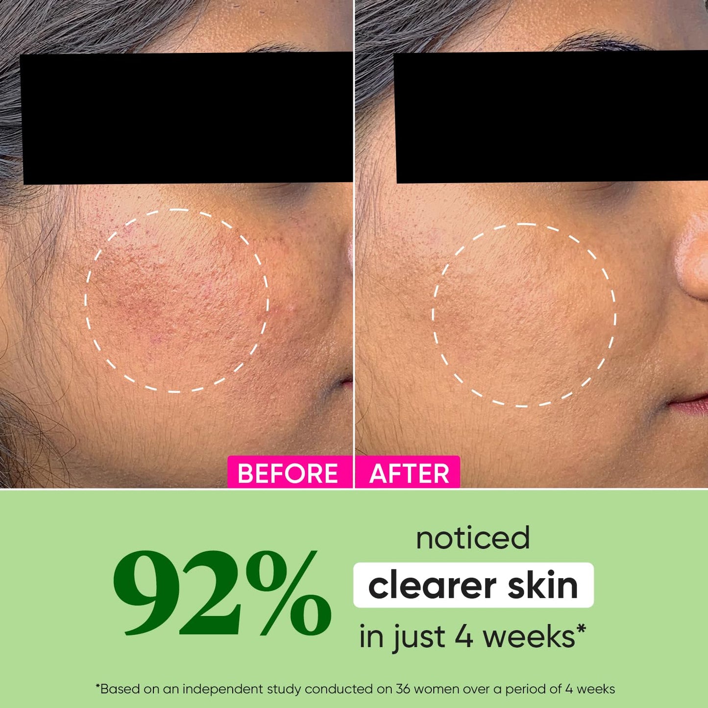 DOT & KEY Cica + Niacinamide Oil Free Moisturizer For Acne Prone Skin Oil Free & Lightweight Fades Dark Spots & Blemishes, Soothes Redness Acne Cream For Oily Acne Prone & Sensitive Skin 50Gm