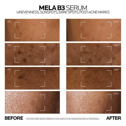 La Roche-Posay Mela B3 Anti-Dark Spot Serum |Corrects Pigmentation, Sun Spots, Age Spots & Post-Acne Marks with Melasyl + 10% Niacinamide for even skin, 10 ml