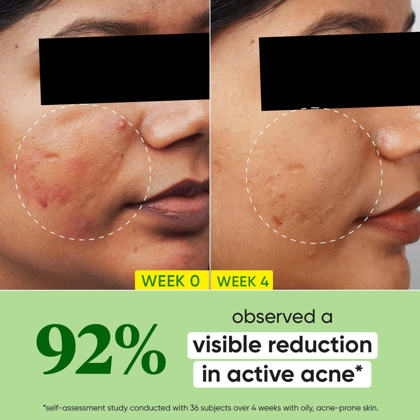 Dot & Key 2% Salicylic Acid + Cica Anti Acne Serum with Zinc | Salicylic Acid Serum for Acne and Dark Spots | Serum for Oily Acne Prone Skin & Sensitive Skin | Oil-Free & Non Comedogenic | 20 ml