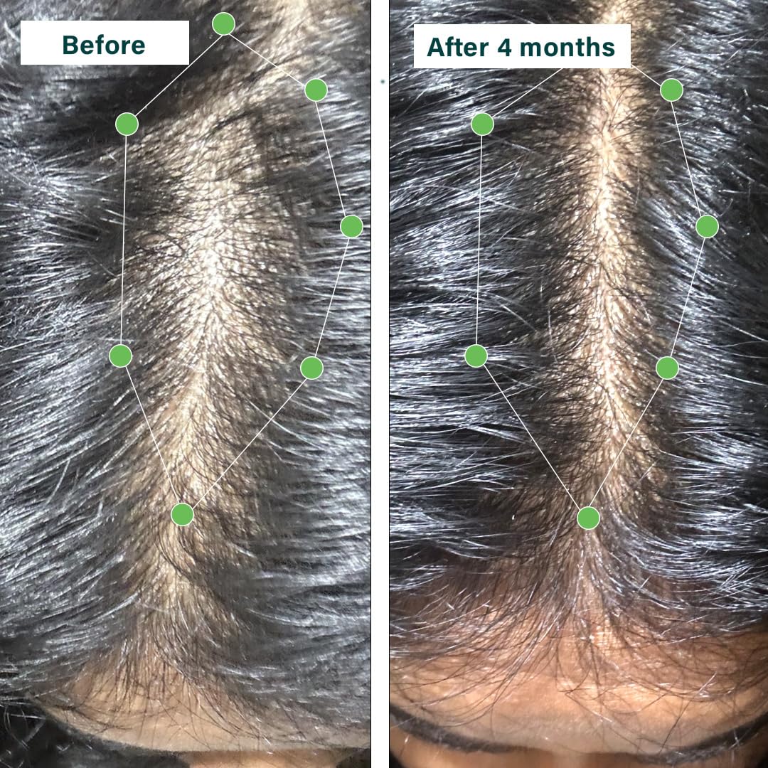 OZiva Hair Vitamin Capsules for Hair Growth & Hair Fall Control,100% Natural with Biotin, Iron, DHT Blocker & Vitamin E,Clinically Proven Hair Growth Supplements for Women & Men,60 capsules