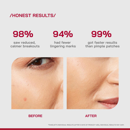 /PHD/ Salicylic Acid Acne Spot Treatment Gel 10g | Fast-Acting Pimple Remover & Acne Spot Corrector | Clear Gel with Peptazinâ„¢ Complex | Alternative to Pimple Patches | Salicylic Acid Gel for Face | Targets Breakouts & Reduces Spots Instantly