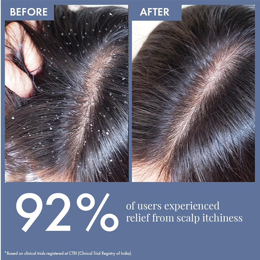 ThriveCo Anti Dandruff Hair Serum Pre-Shampoo Dandruff Treatment for Itchy, Dry & Flaky Scalp | With Octopirox, Pentavitin & Arginine | Reduces Hair Breakage & Strengthens Hair for Men & Women | 10ml