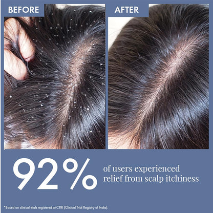 ThriveCo Anti Dandruff Hair Serum Pre-Shampoo Dandruff Treatment for Itchy, Dry & Flaky Scalp | With Octopirox, Pentavitin & Arginine | Reduces Hair Breakage & Strengthens Hair for Men & Women | 10ml