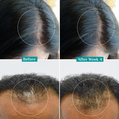 PILGRIM Redensyl 3%+Anagain 4% Advanced Hair Growth Serum For Scalp(50Ml) With Natural Ingredients Korean Black Rice,Controls Hair Fall,Stimulates,Increases Hair Density|Hairgrowth Serum For Unisex