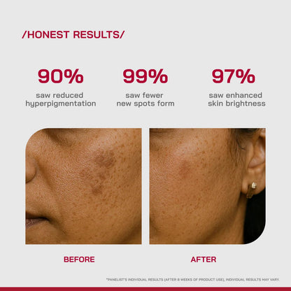 Proven Honest Derma /PHD/ 2% Alpha Arbutin Depigmentation Serum | Alpha Arbutin for Pigmentation & Dark Spot | Pigmentation serum for Women & Men | Tyrobrightâ„¢, Niacinamide | Tan removal | Fragrance-Free | 30ml