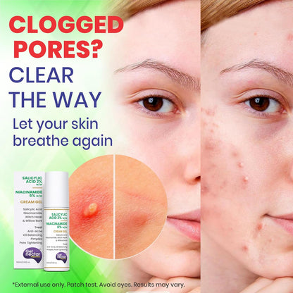 Get Nectar Happiness 2% Salicylic Acid 6% Niacinamide Acne Treatment Gel with Oil-Free for Active Acne, Pimples Oil Balancing, Pore Tightening & Brightens and Smoothens 50ml